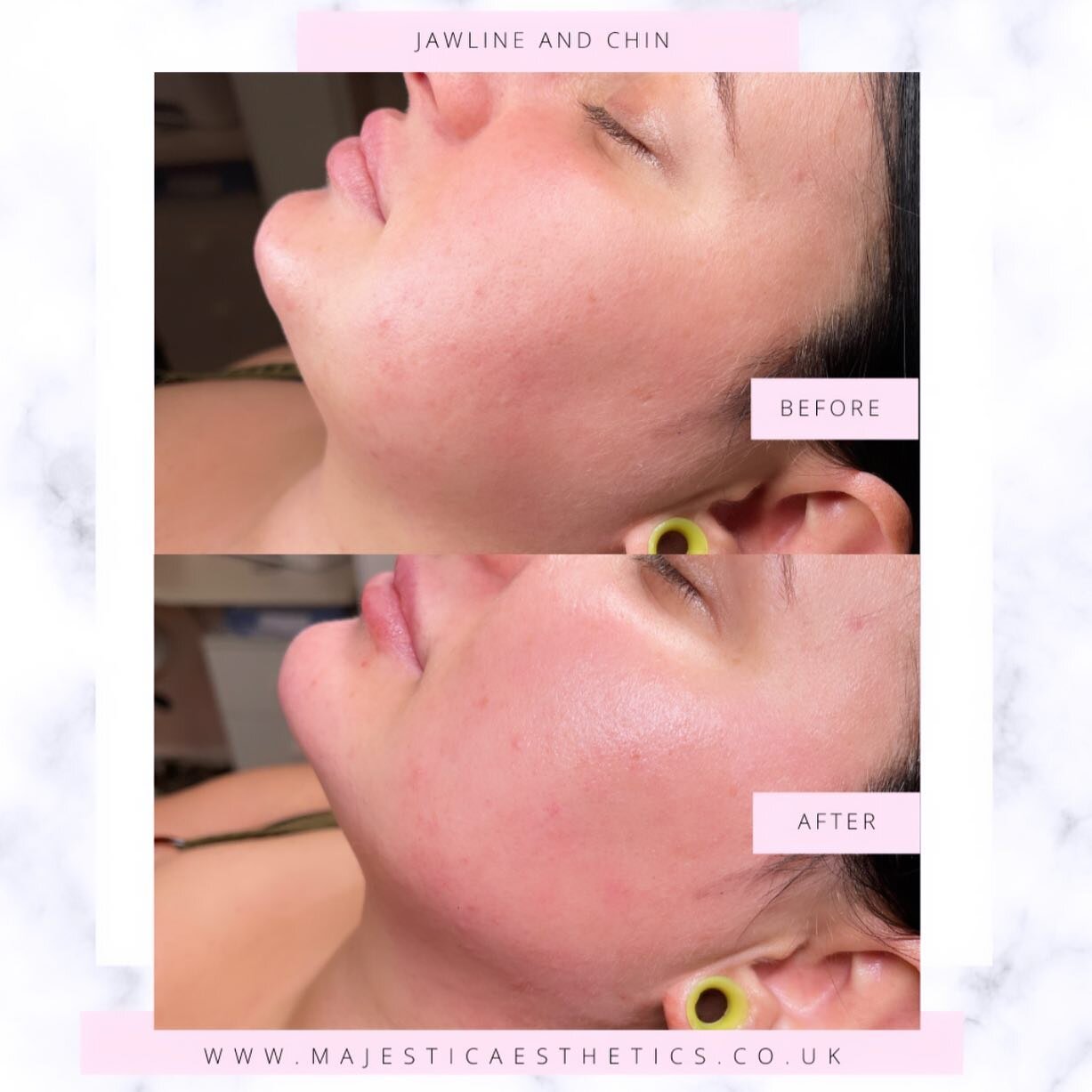 Jawline and chin contouring 👩🏼&zwj;⚕️

3ml package 

What can chin filler do?

- A chin filler treatment is a non-surgical chin augmentation treatment that brings back proportion and harmony to the face. Optimising the chin with a dermal filler tre