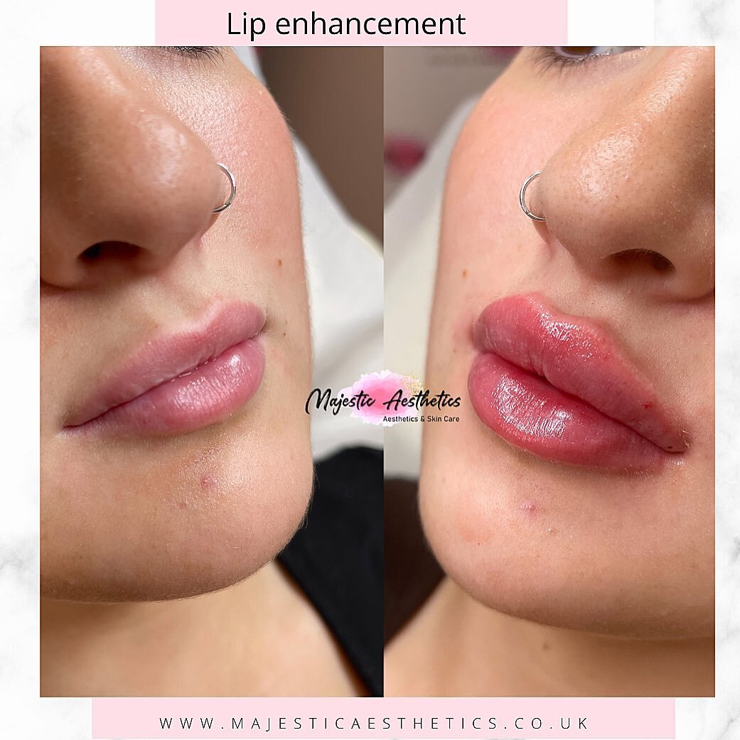 How gorgeous are these 👄💋

1.1ml Russian lips (some swelling can be seen straight after treatment) this is normal.
Some people will swell more than others, this can take around 48-72 hours to settle depending on factors such as individual lifestyle
