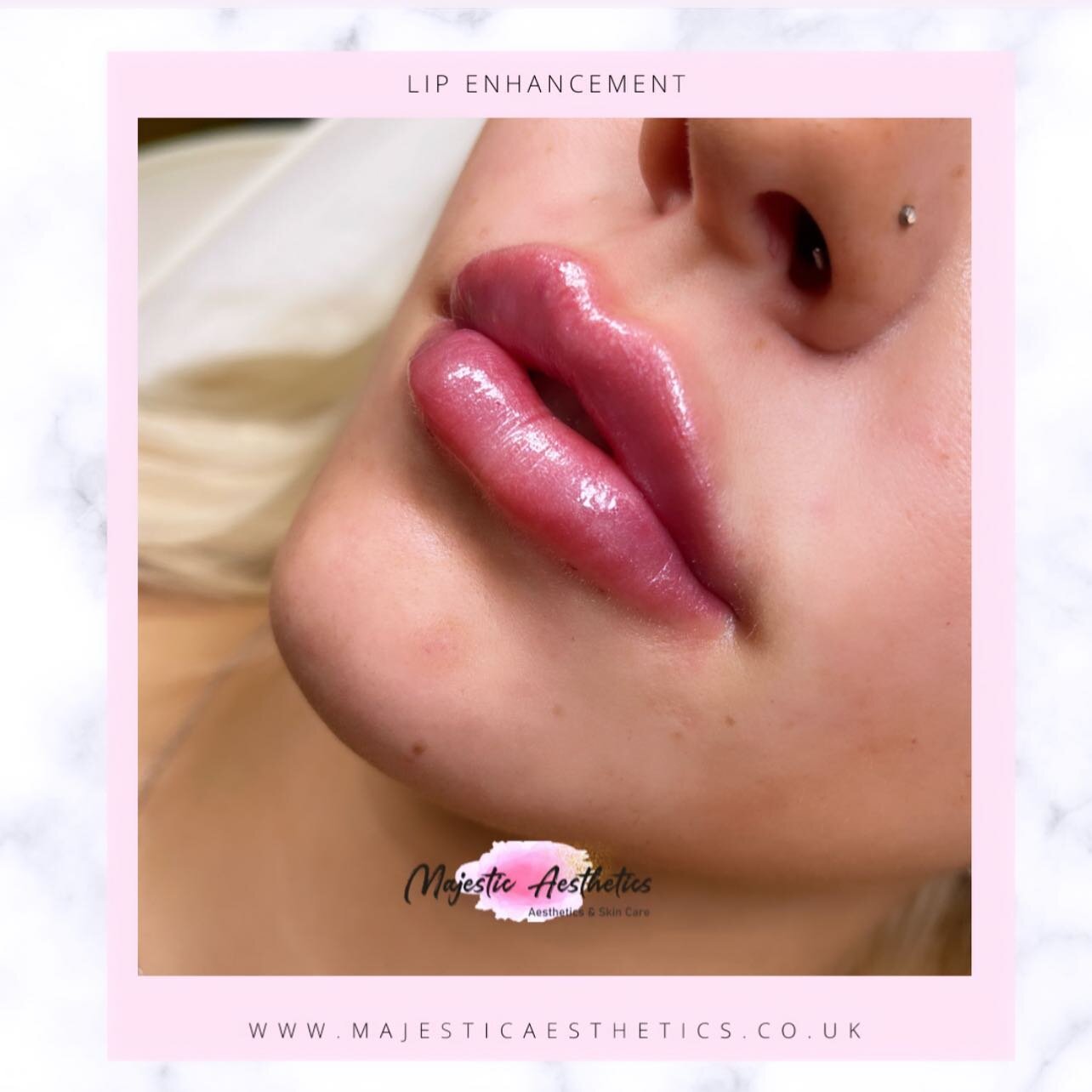 Swipe for before 👄

&lsquo;Russian&rsquo; lift and lips. 2ml in total spread over two appointments to build the lips up.

@majestic_aesthetics