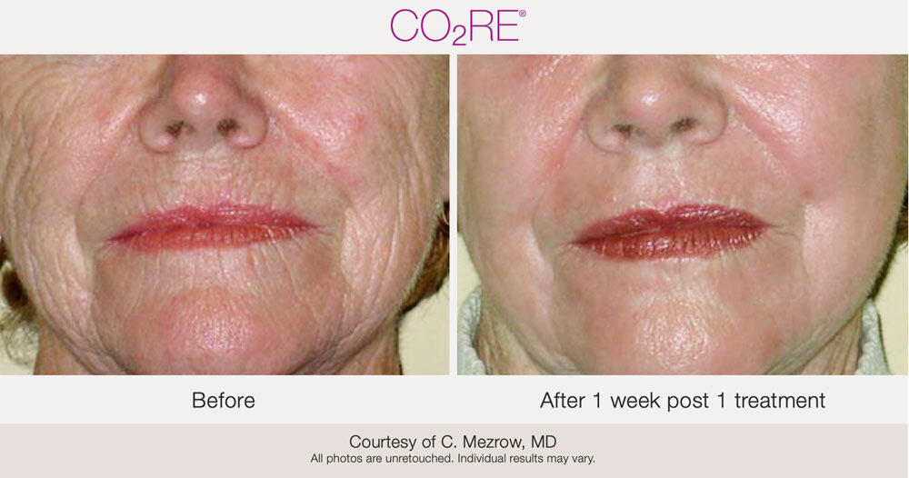 CO2 Laser Resurfacing - The Norwich Face & Body Clinic