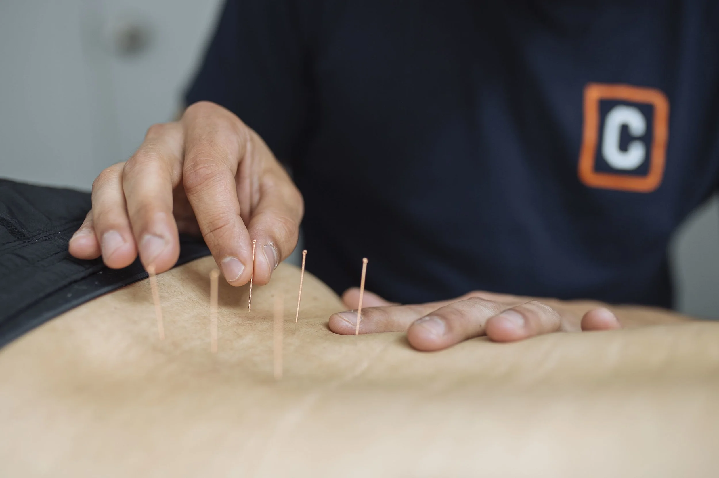 Person receiving acupuncture treatment with thin needles inserted into their back.