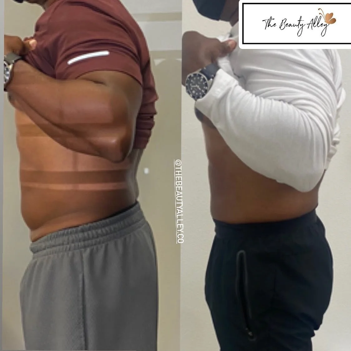 Helping you get rid of that layer of stubborn fat that just won&rsquo;t go away no matter how much you diet or workout 🏋️&zwj;♂️ DONT MISS OUR SPECIAL OF $100 OOFF ANY TREATMENT ✨ (offer expires in just 7 days)