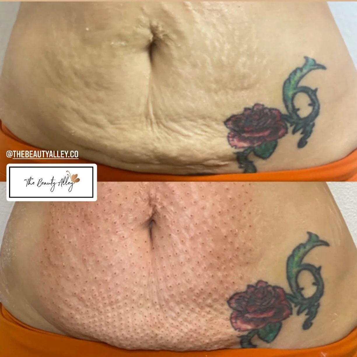 Even the rose expanded 🌹 💕 can't wait to see the final results in 6 weeks book your fibroblast appointments on our site  thebeautyalley.co or call us 9163048199