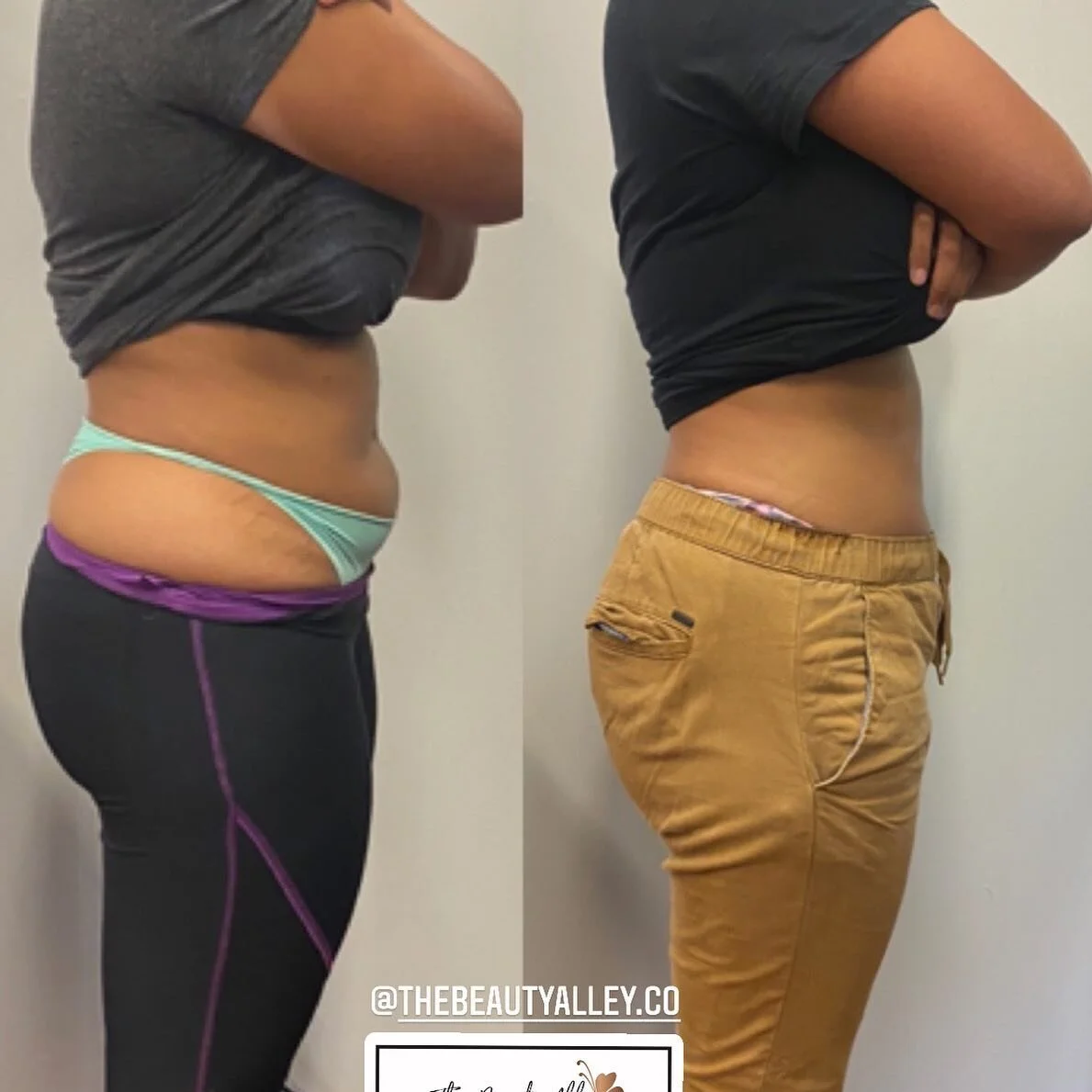 Bathing Suit Season Is Here! ☀️ 👙 let us help you achieve your body  goals quicker before summer ends! 🏖