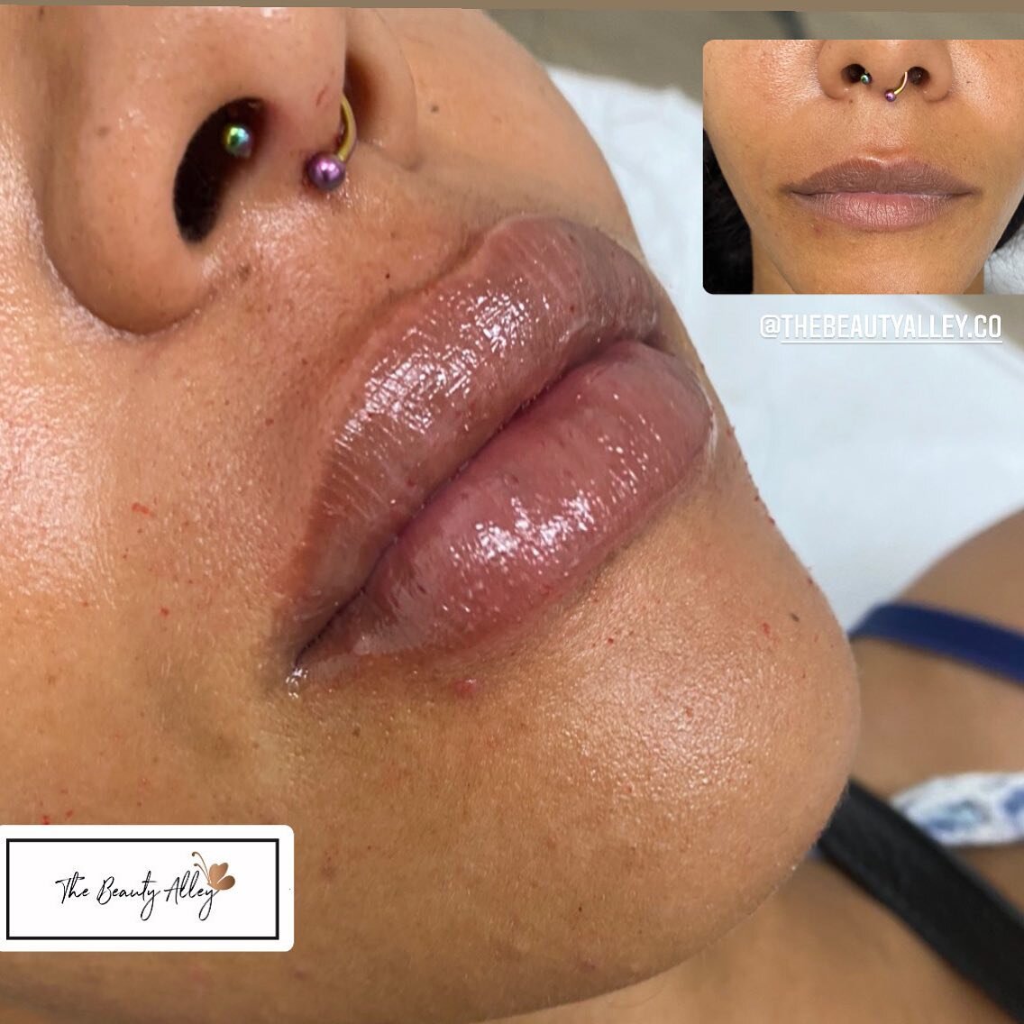 Mega Deep Filler 
Needless. Lasts 6-8 months 
(Particle Size: 0.28-0.5mm)
💰$250 1ML
💰$350 2ML