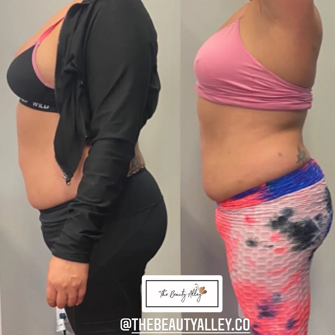 the treatment will only work at its optimum if the after care is followed: 
- drink at least 1.5L of water prior to and following your treatment. Stagger 2L intake of water over 24 hours, for three days post-treatment.
- The body requires three days 