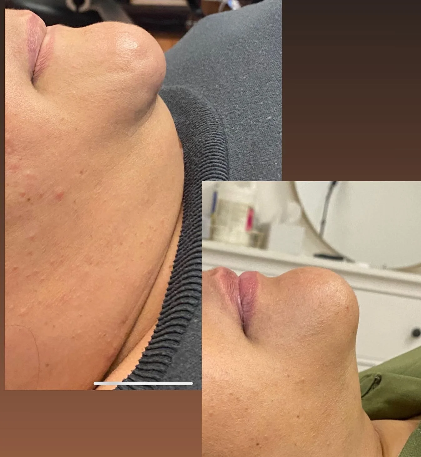 KYBELLA- &bull;is a Deoxycholic acid that induces the destruction of normal fat cells in the face for a sharper jaw line 
&mdash;&mdash;&mdash;&mdash;&mdash;&mdash;&mdash;&mdash;&mdash;&mdash;&mdash;&mdash;
CALL/TEXT TO BOOK YOUR APPOINTMENTS OR VISI