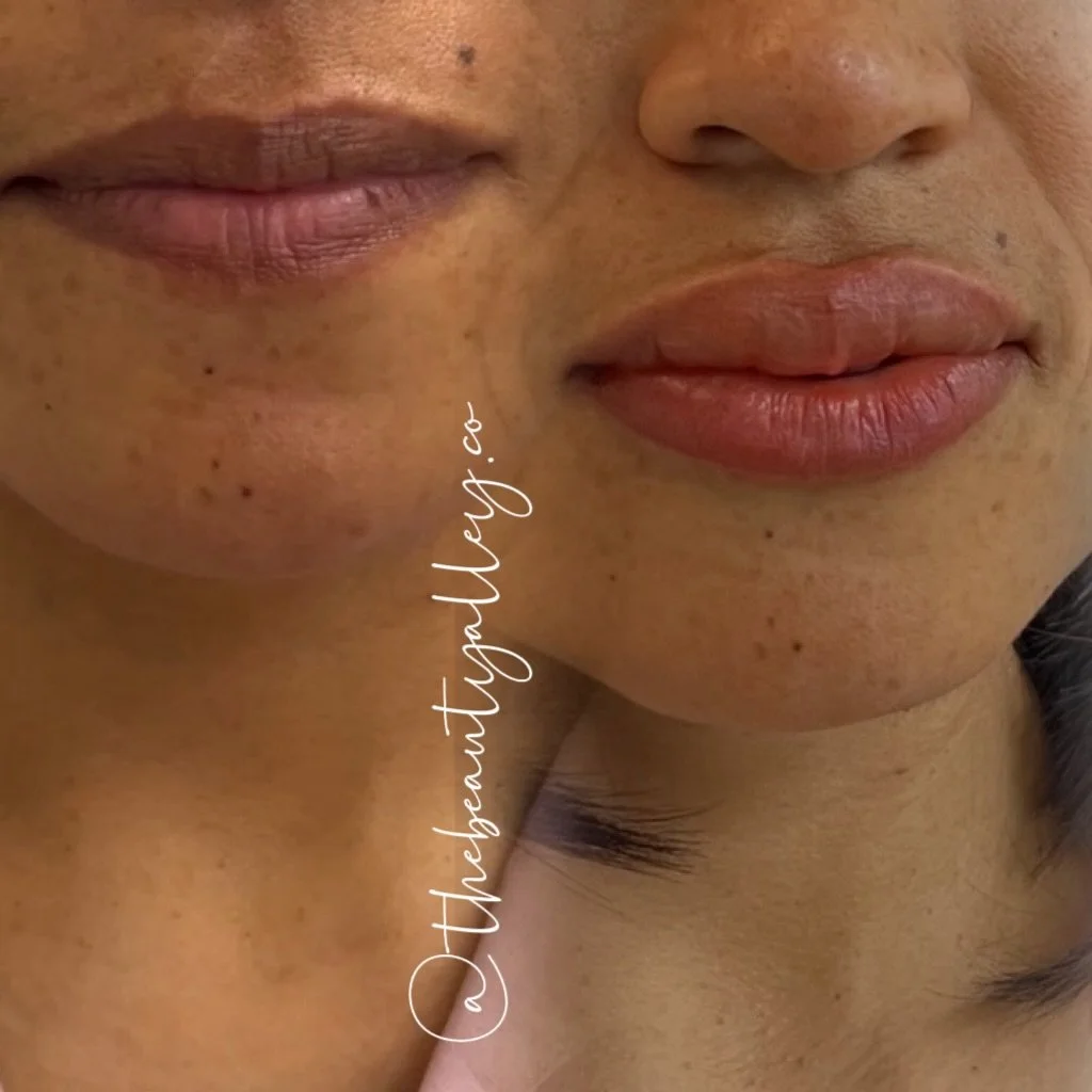 💄 Lip Neutralization Tattoo 💄

Lip neutralization is a specialized cosmetic tattoo designed to correct dark, cool, or uneven lip tones and restore a more balanced, natural-looking color&mdash;not to &ldquo;add lipstick,&rdquo; but to bring the lips