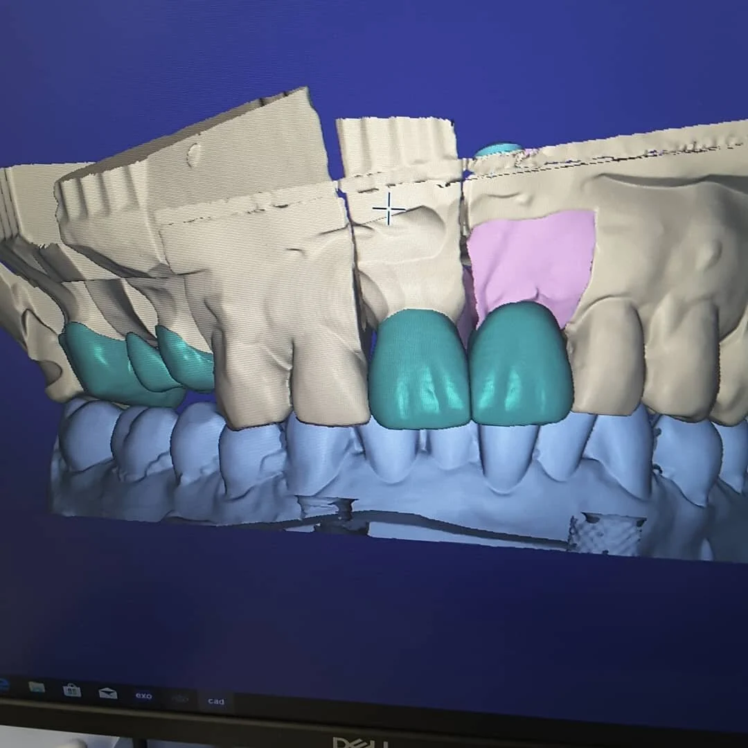 Designing implant crowns