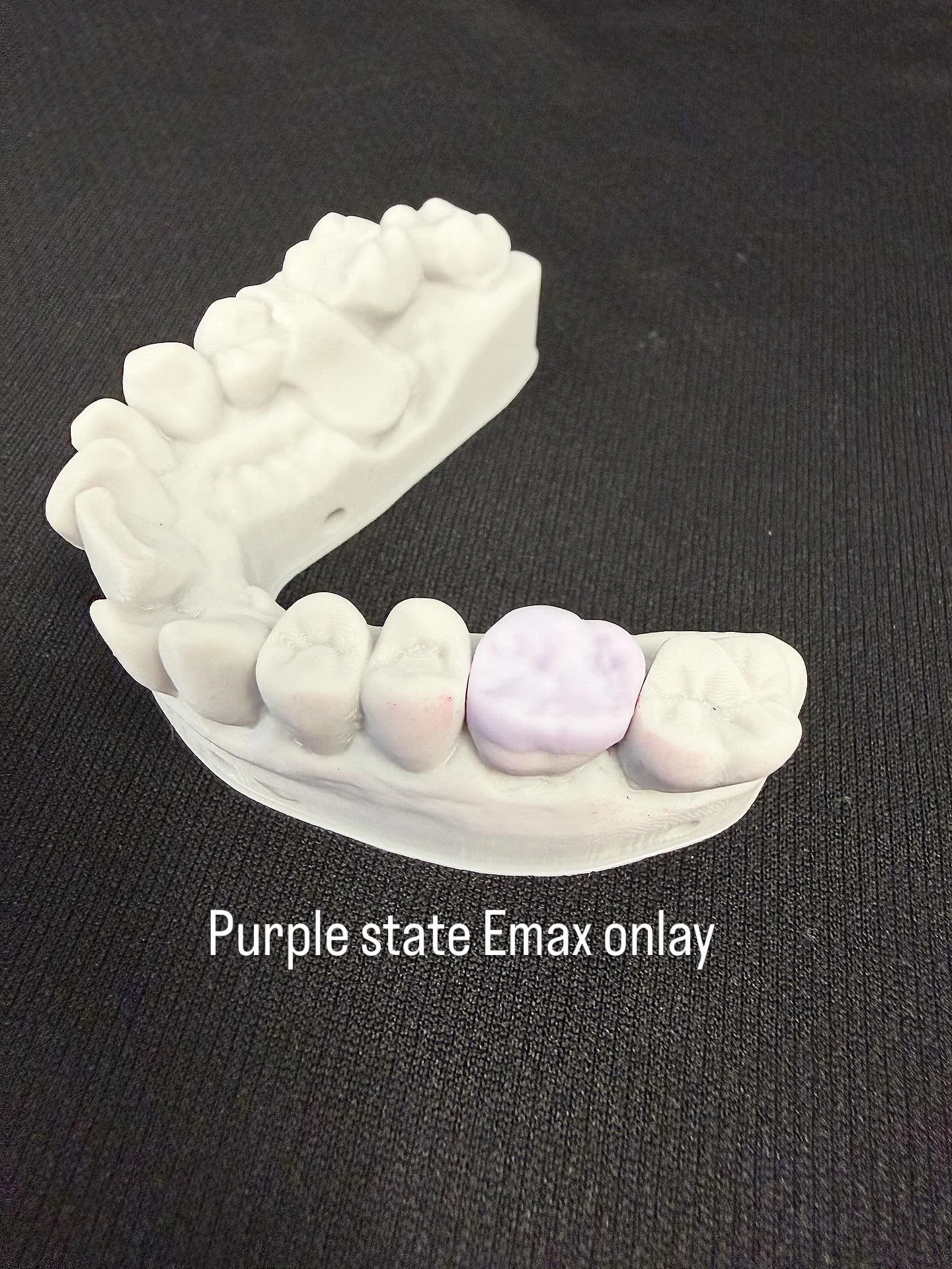 We can now offer a new service! Emax crowns,inlays or onlays in a day if scan received by 12pm. #emax #vhfn4plus #digitaldentistry #digitaldentallaboratory #bayviewdentalceramics