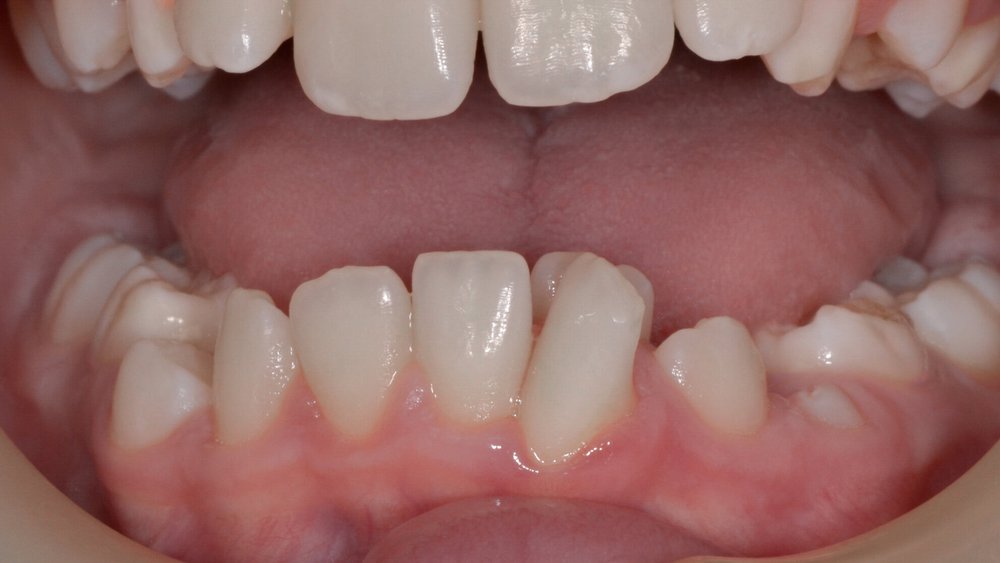 Lower Incisor Extraction An Alternative Approach — eLINE Orthodontics