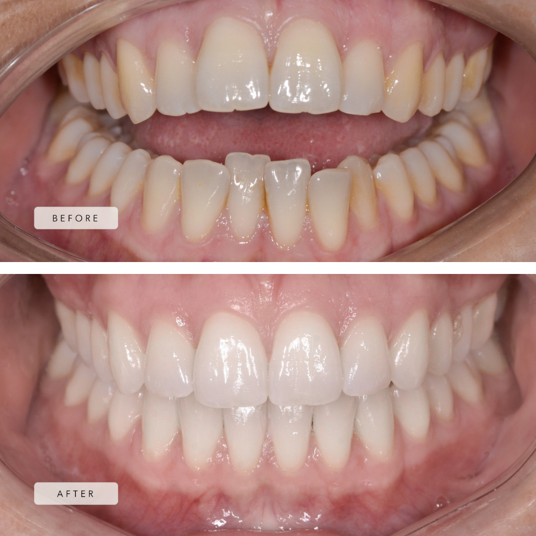 Incomplete Overbite Case - Invisalign