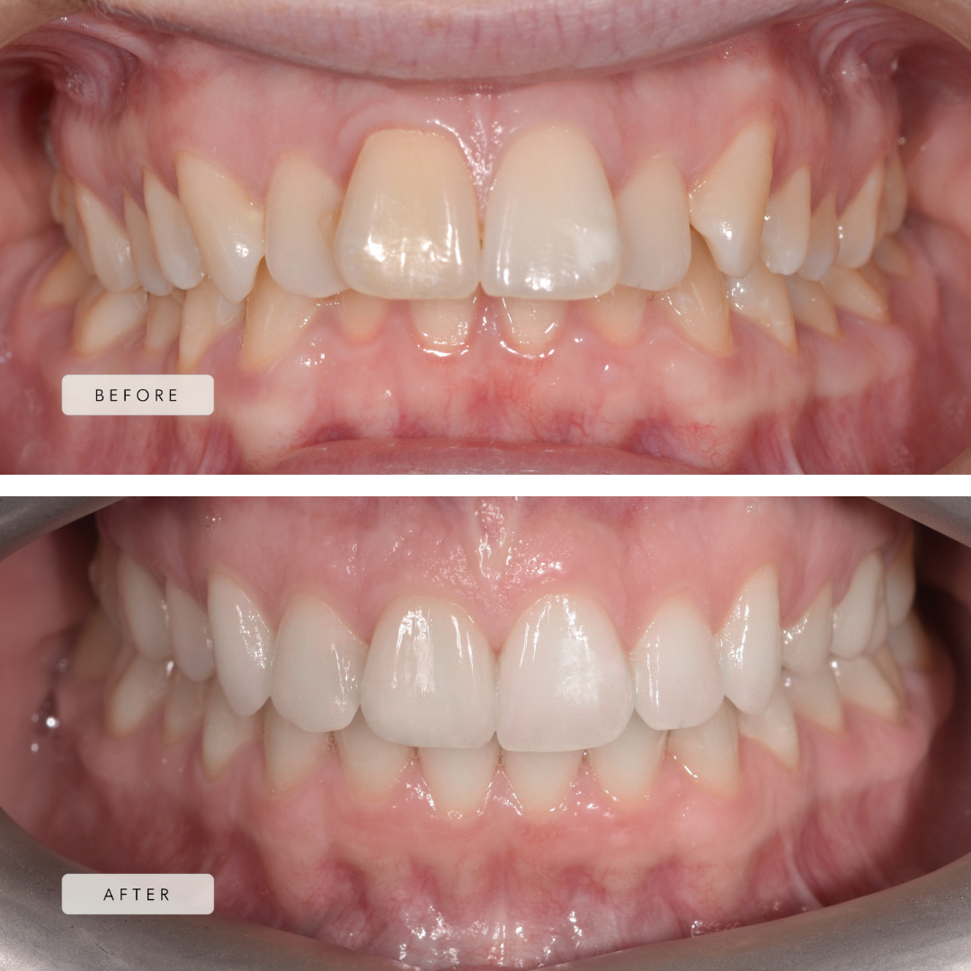 Upper Extraction Case - Lingual Appliances, Braces