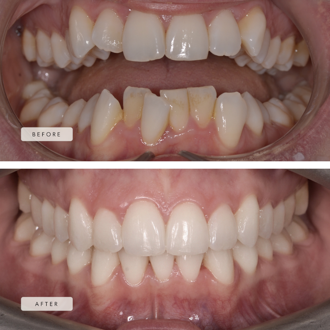 Lower Incisor Extraction Case - Braces
