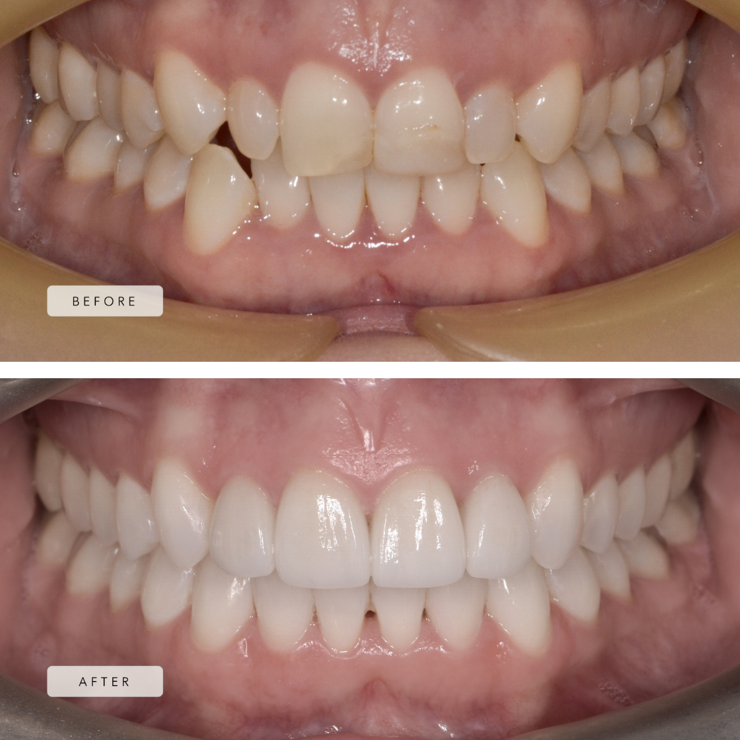 Orthodontics for Adults — eLINE Orthodontics