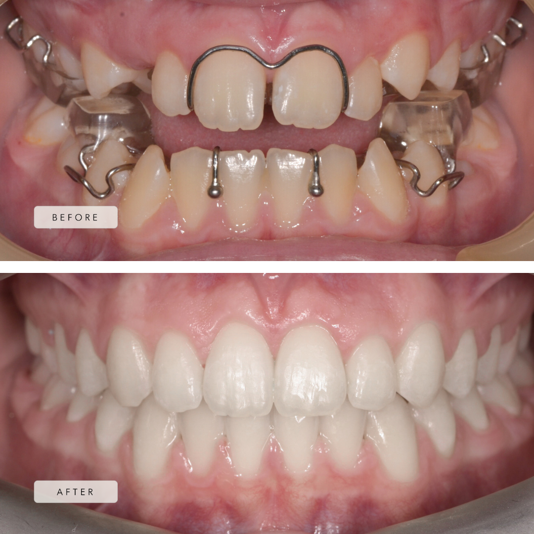 Complex Case - Twin Block and Braces