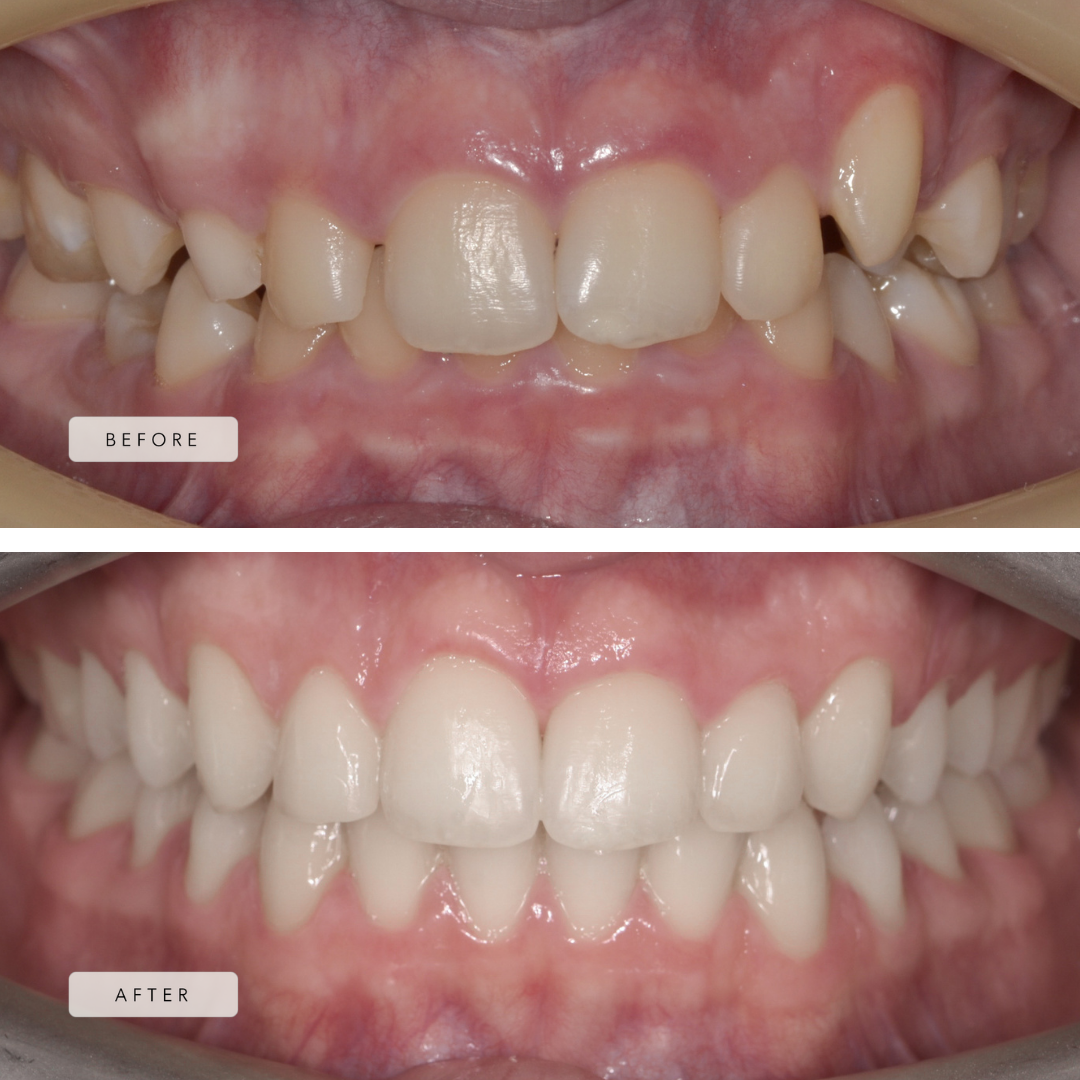 Crowding Case - Braces