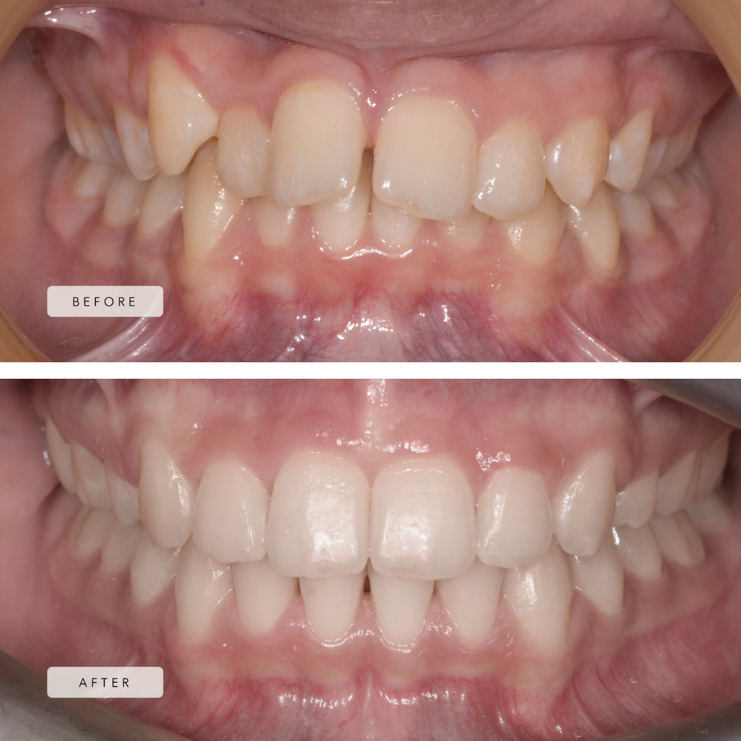 Crowding and Extractions Case - Braces