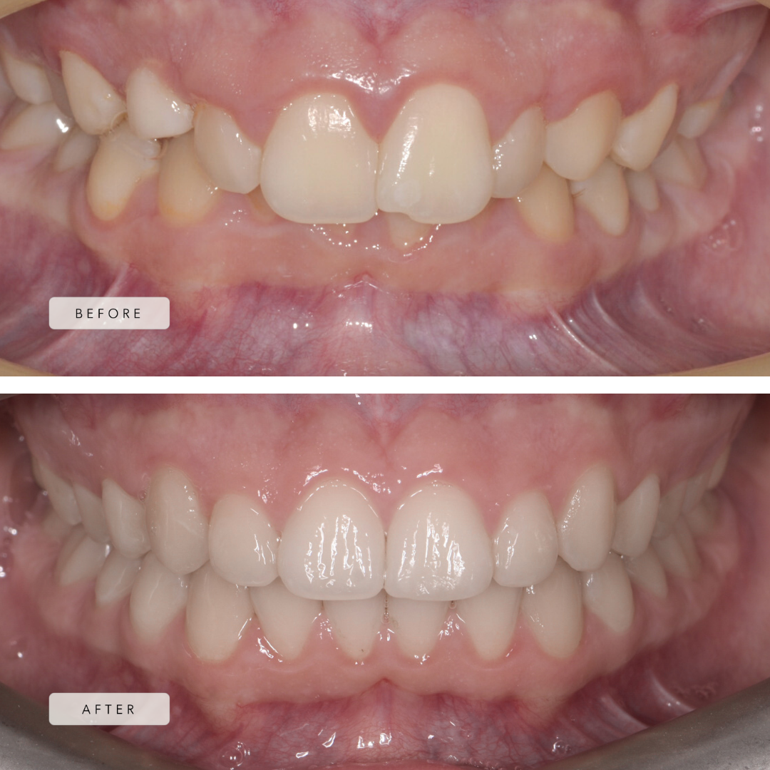 Narrow Arches and Crowding Case - Braces