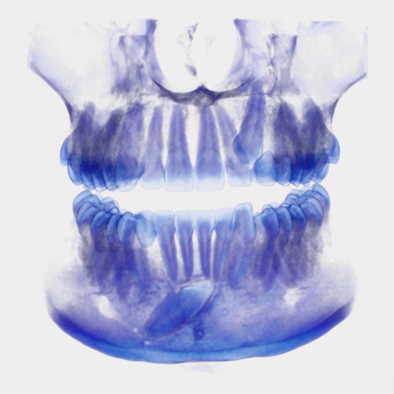 CBCT Impacted Canines