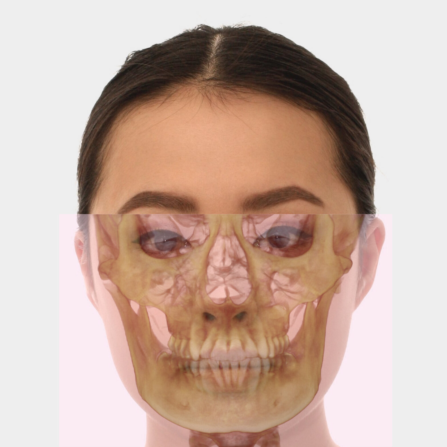 CBCT Frontal Analysis