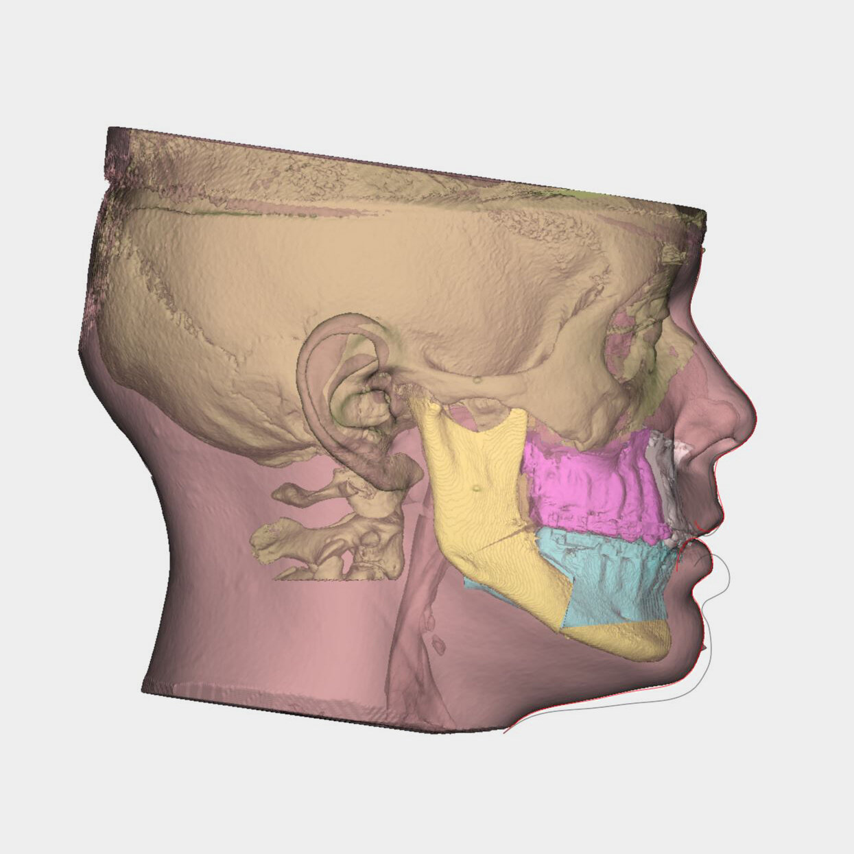 3D Surgical Planning