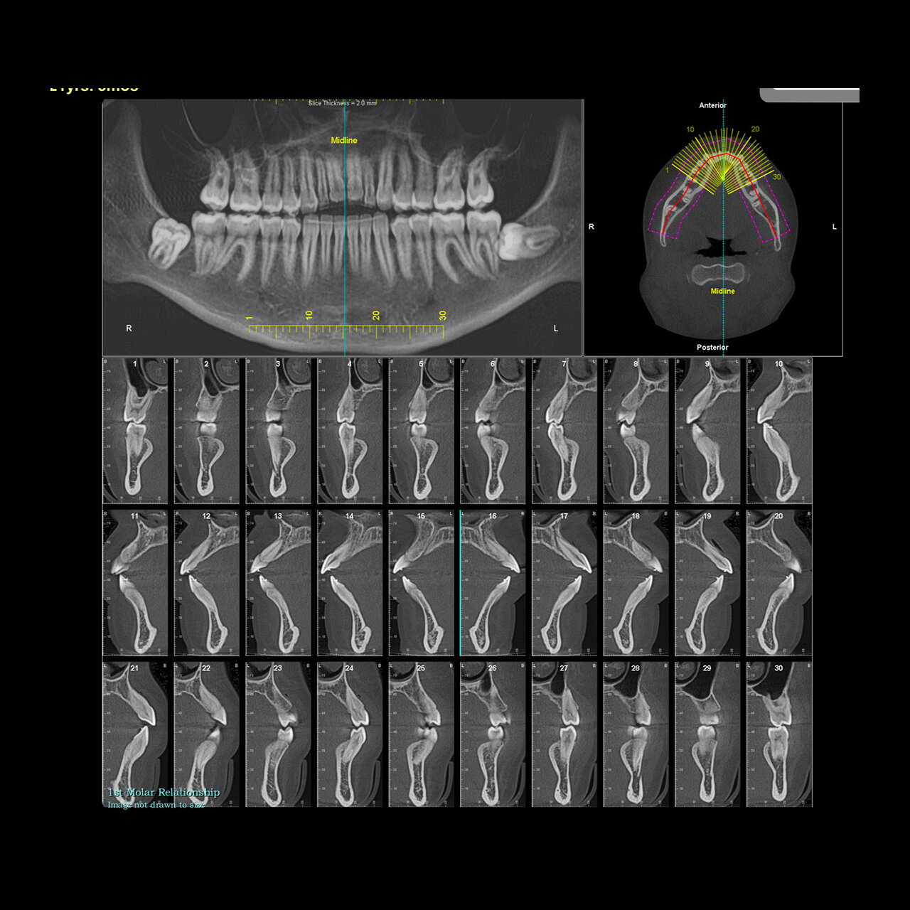 CBCT Bone Assessment