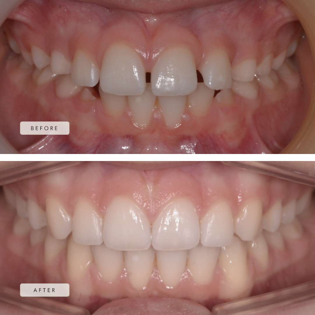 Spacing case - braces