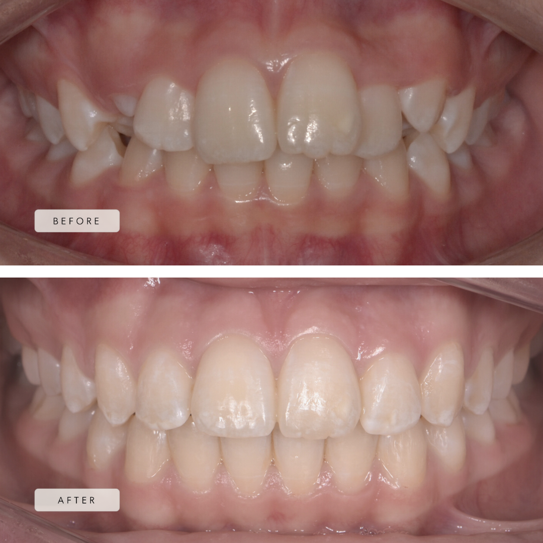 Crowding - Braces