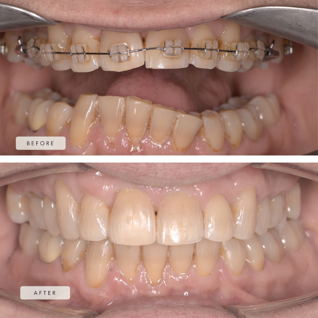 Lower occlusal cant - fixed braces 