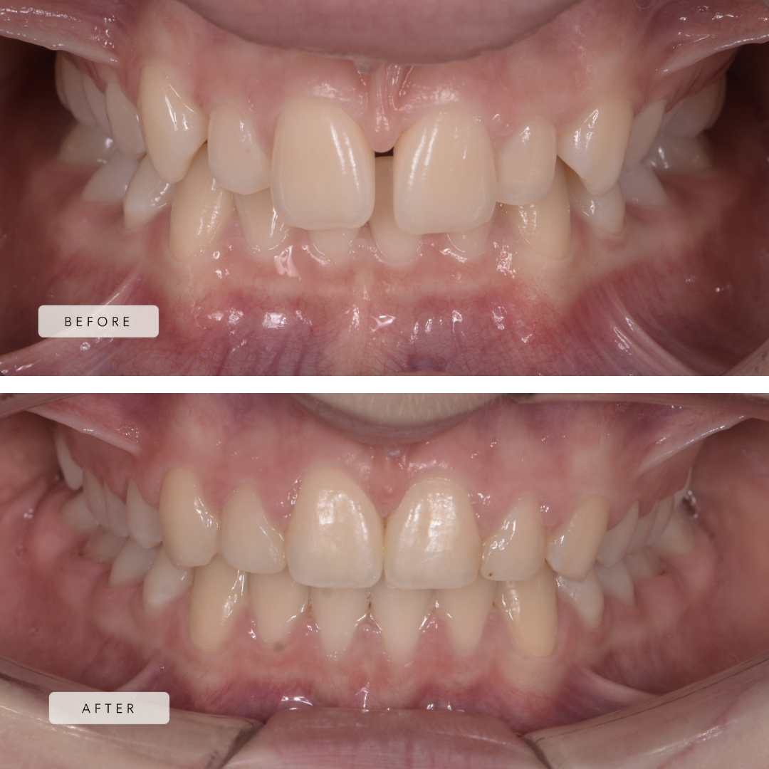 undersized teeth - fixed braces