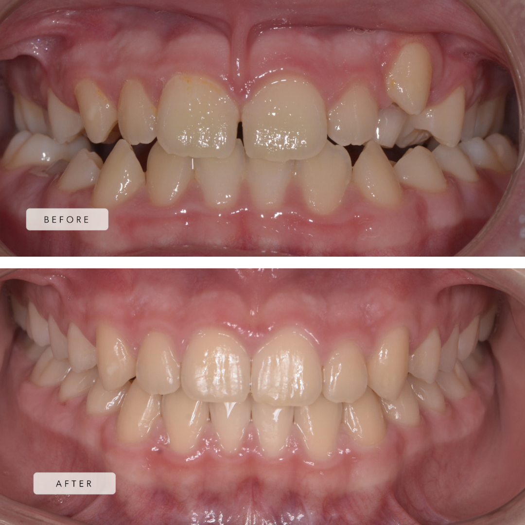 Bi-lateral cross bite + fixed braces