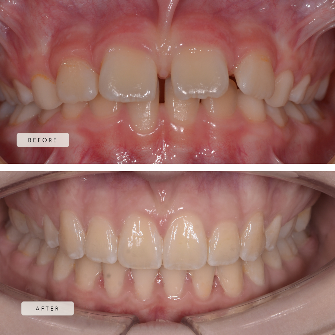 protruding teeth - fixed braces