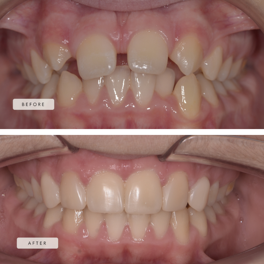 Missing upper laterals with space closure + Braces