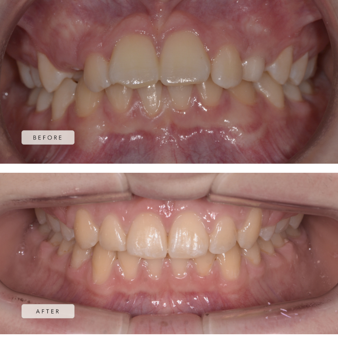 Tooth prominence + braces + upper extractions
