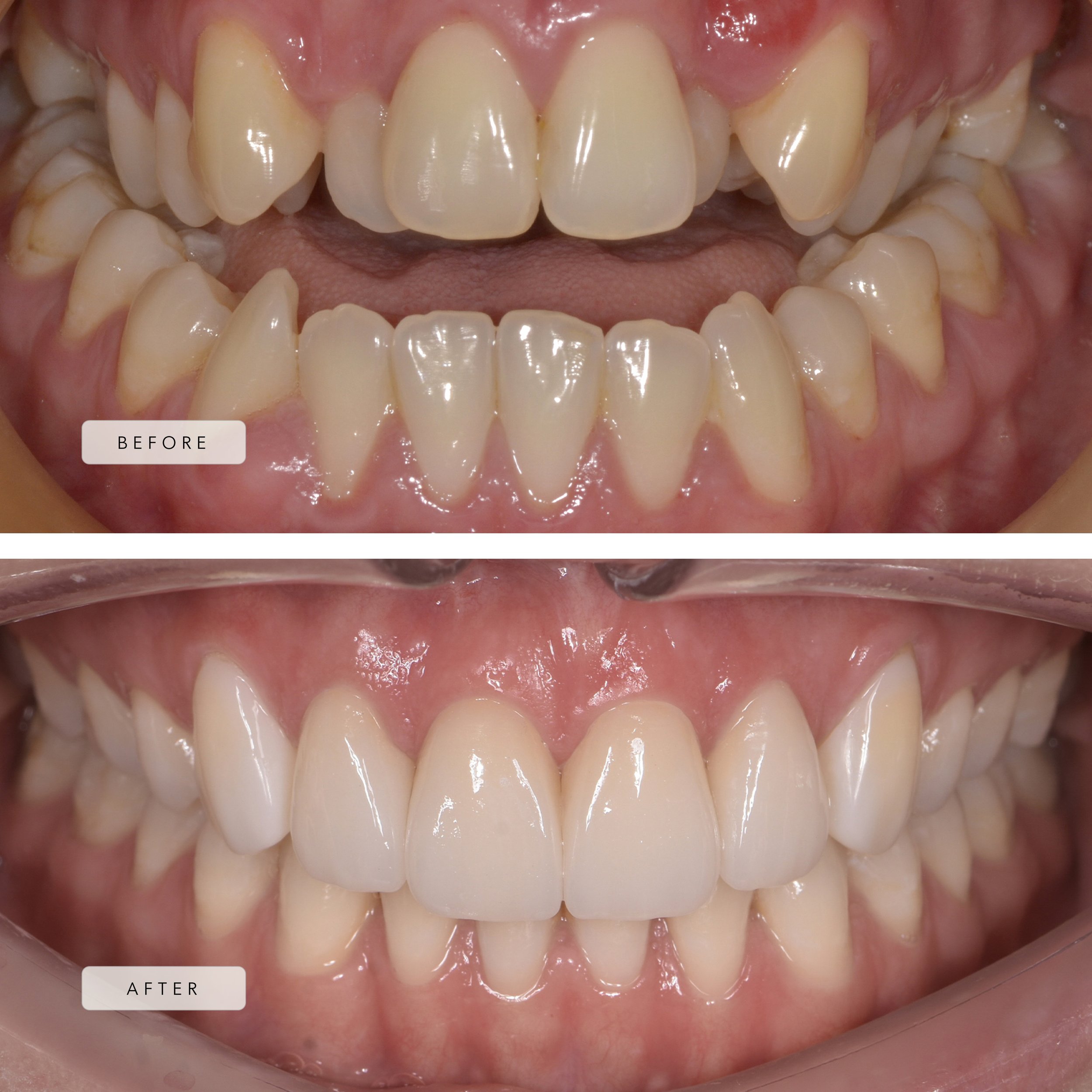 Labial braces + bimaxillary osteotomy + restorative dentistry 