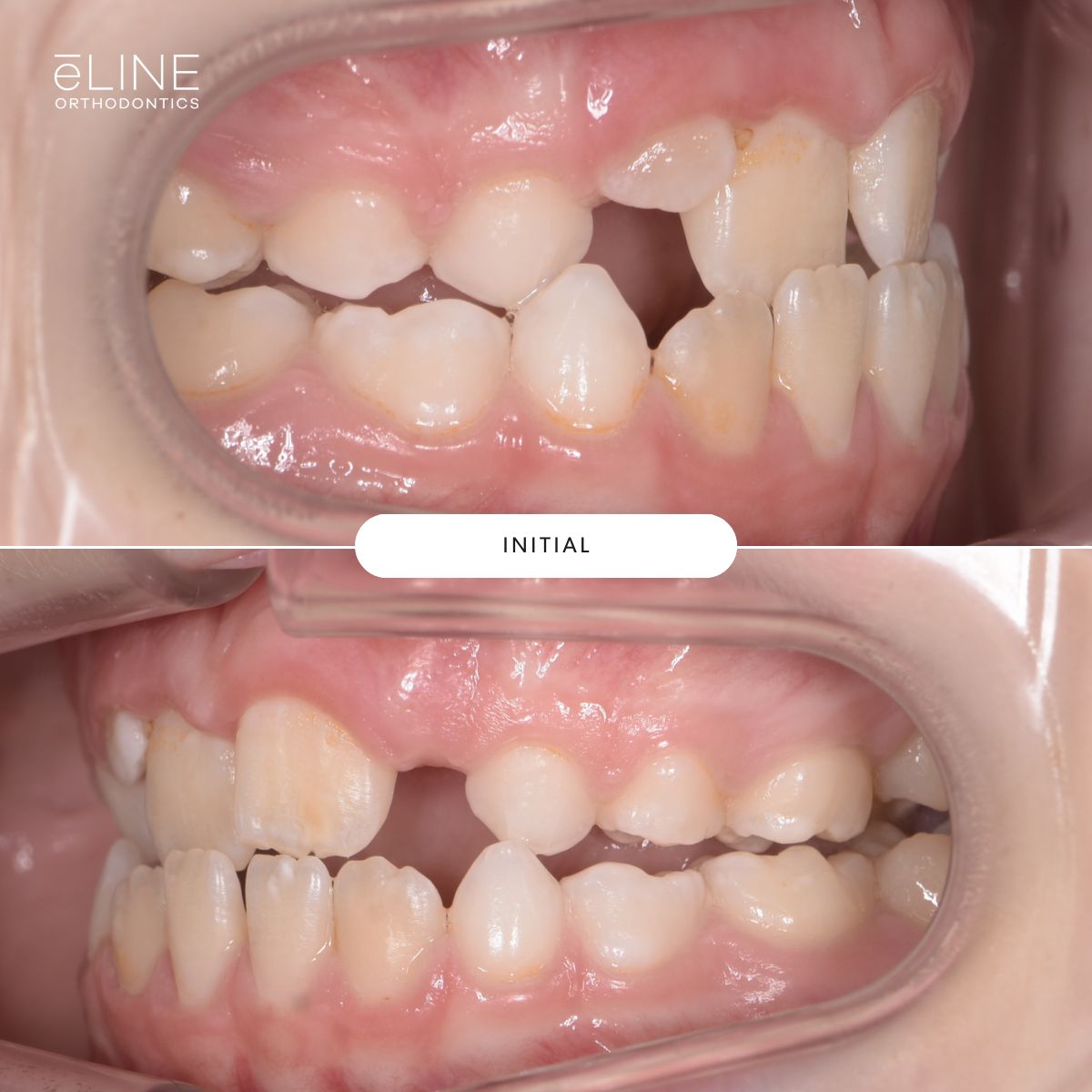 Early Orthodontics Part 1 — eLINE Orthodontics