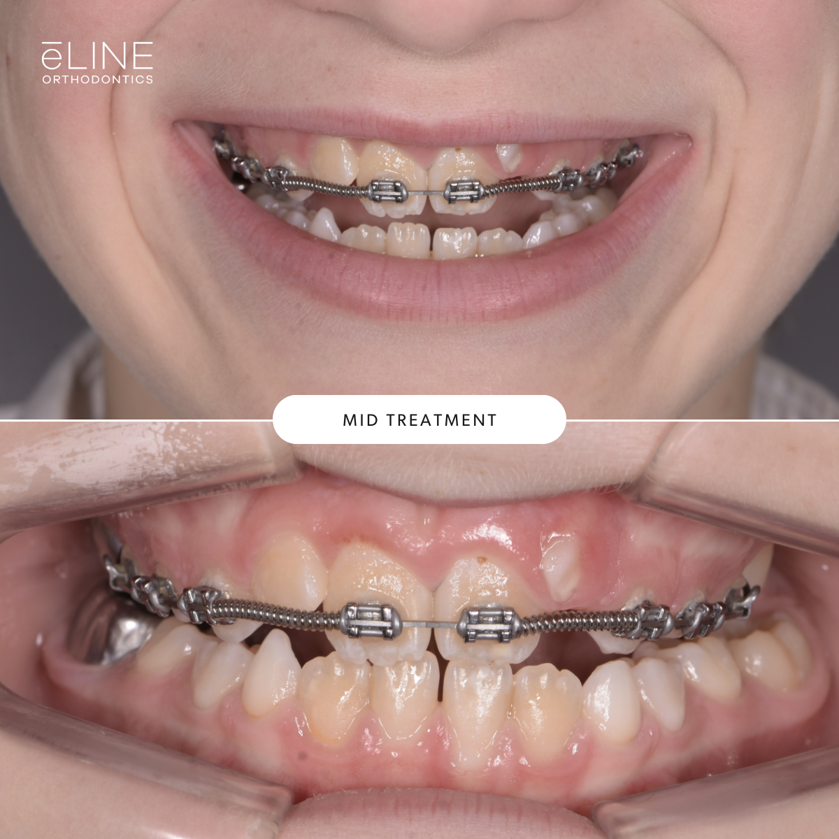 Early Orthodontics Part 1 — eLINE Orthodontics