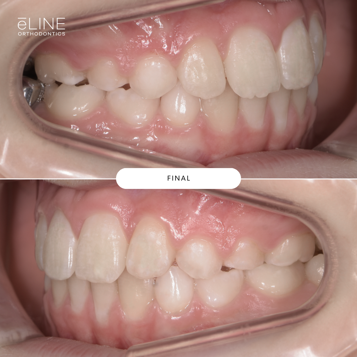 Early Orthodontics Part 1 — eLINE Orthodontics