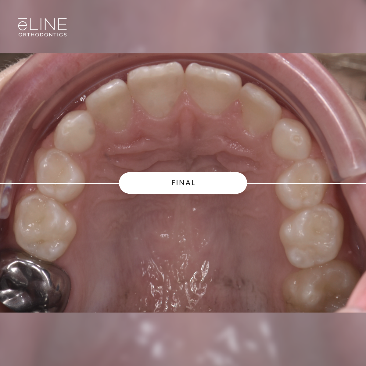 Early Orthodontics Part 1 — eLINE Orthodontics