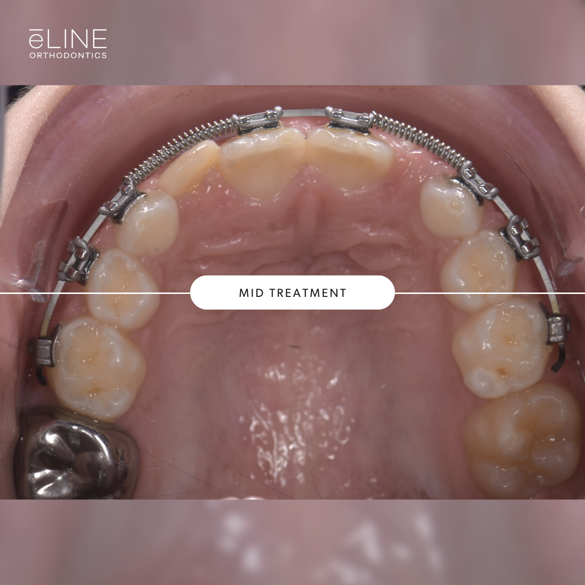 Early Orthodontics Part 1 — eLINE Orthodontics