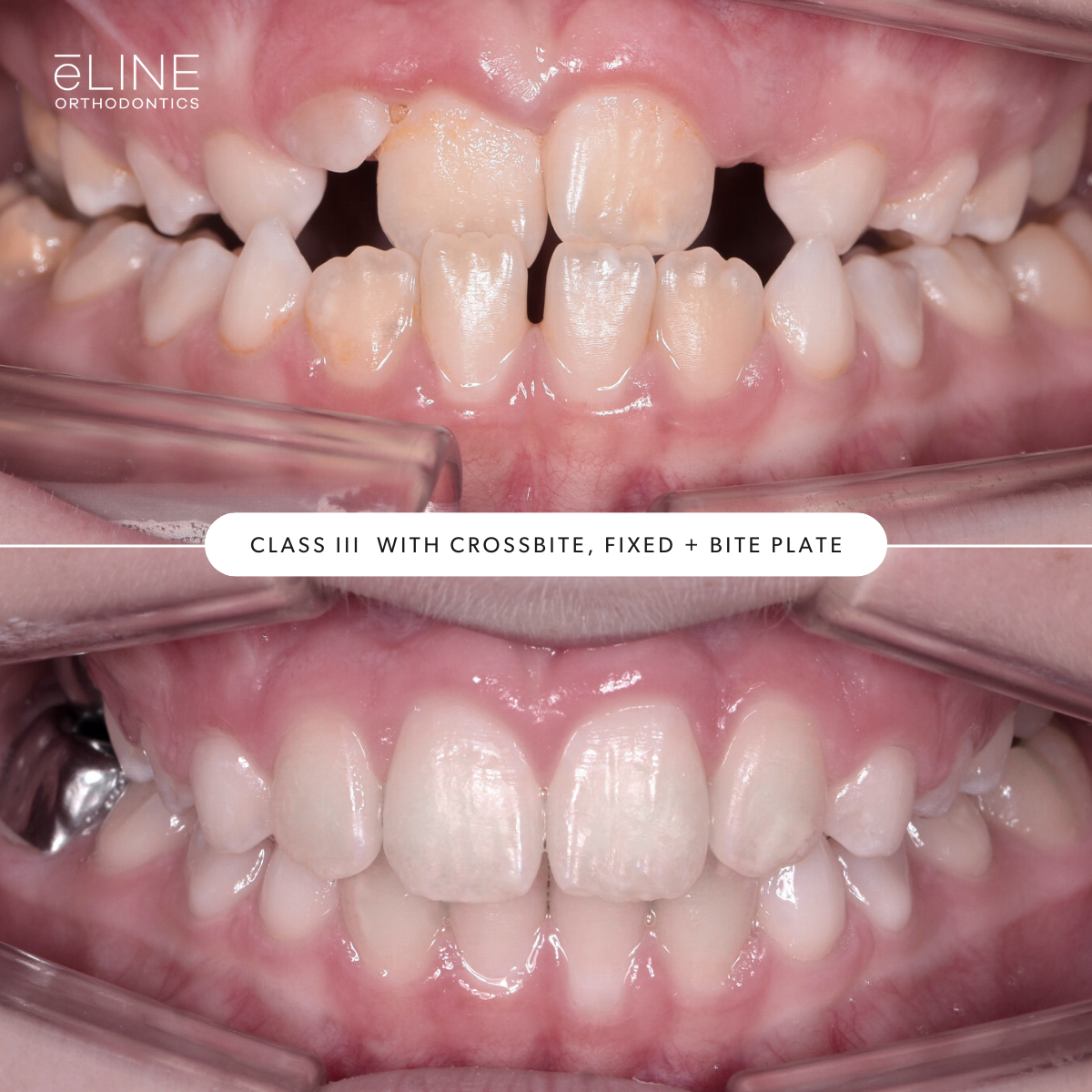 e-LINE Orthodontics for Kids - Early Treatment B_A 1.png