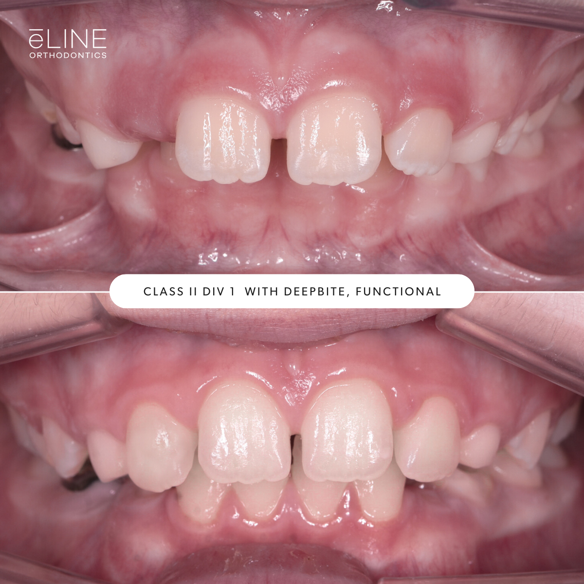 e-LINE Orthodontics for Kids - Early Treatment B_A 3.png