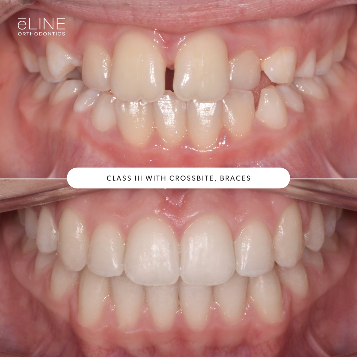 e-LINE Orthodontics for Kids Cases, Before & After.png