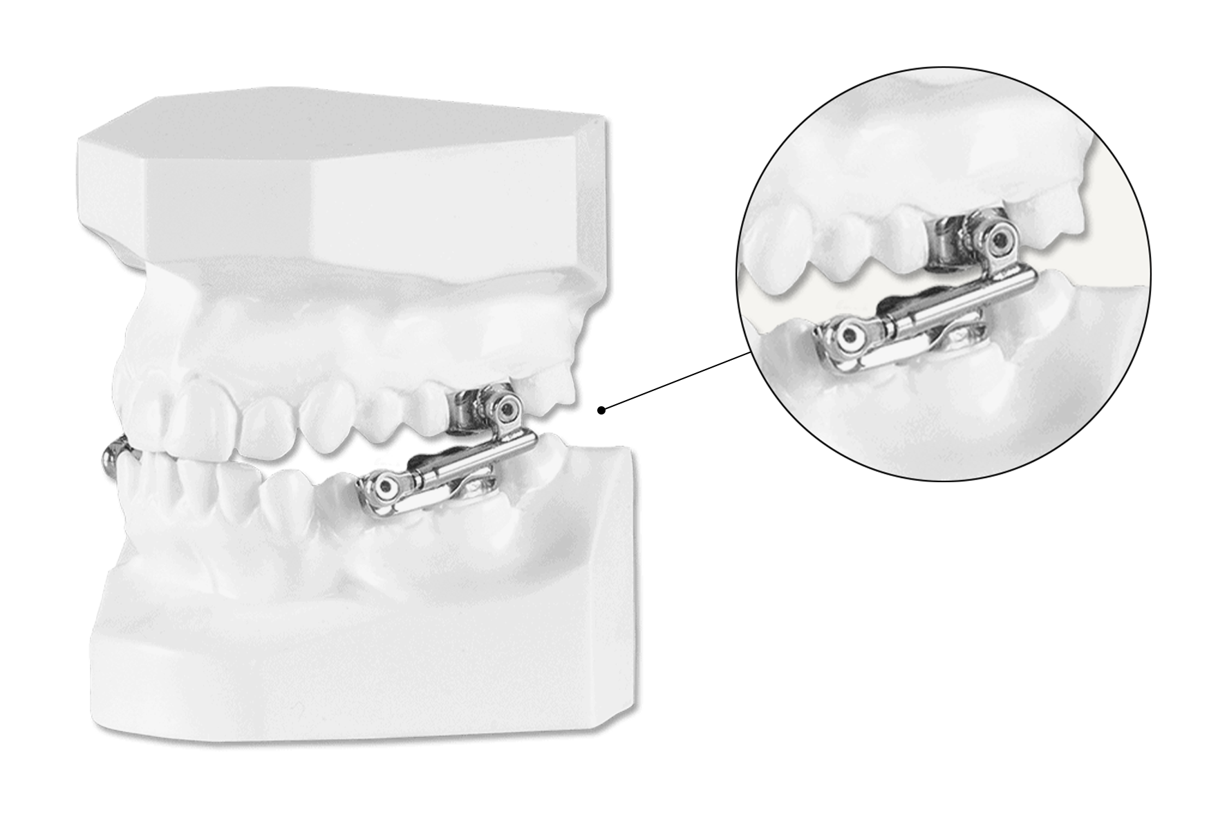 Class II Functional Case Herbst Appliance — eLINE Orthodontics