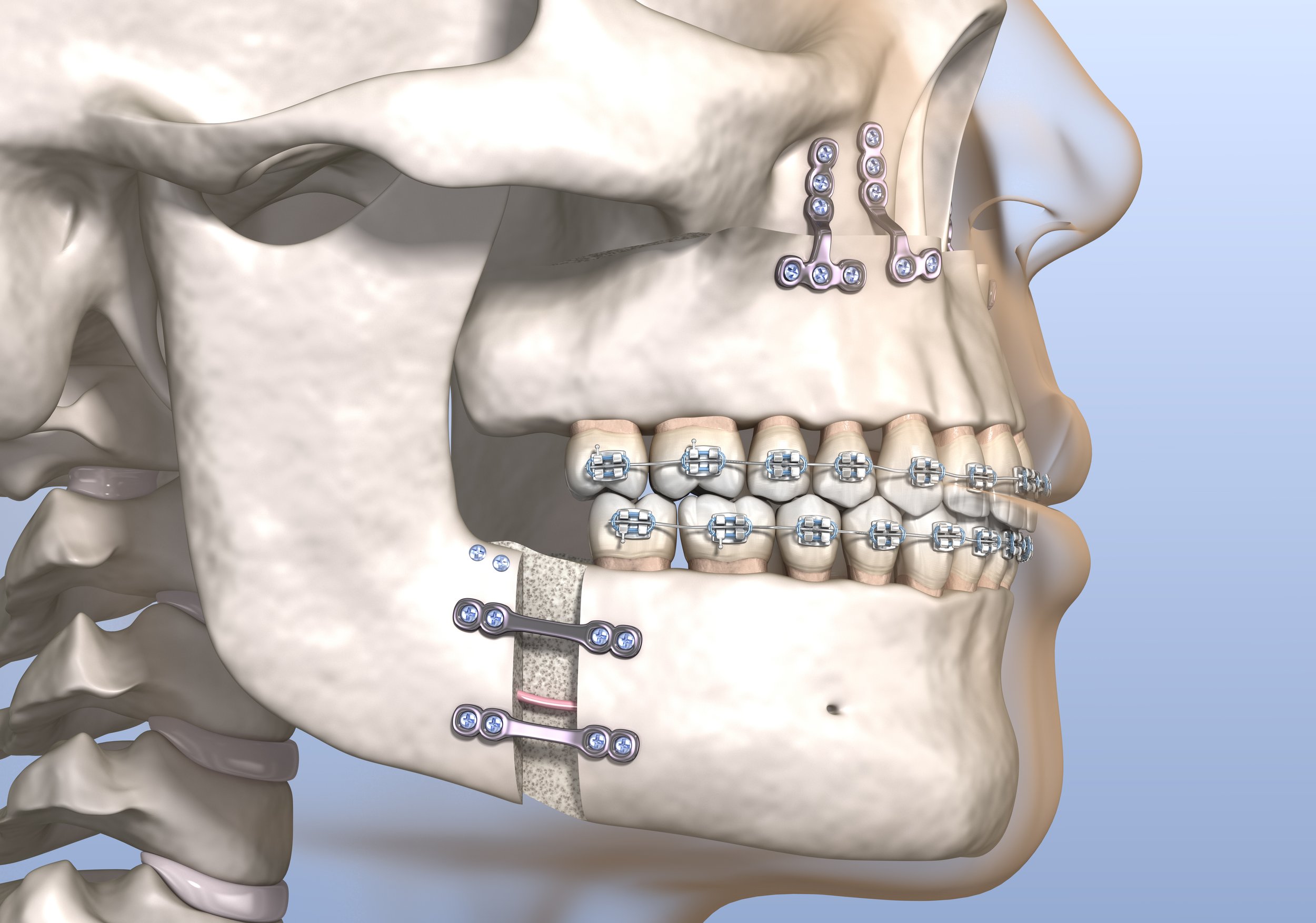 In Depth What Is Orthognathic Surgery And Would You Benefit From It in-depth-what-is-orthognathic-surgery-and-would-you-benefit-from-it