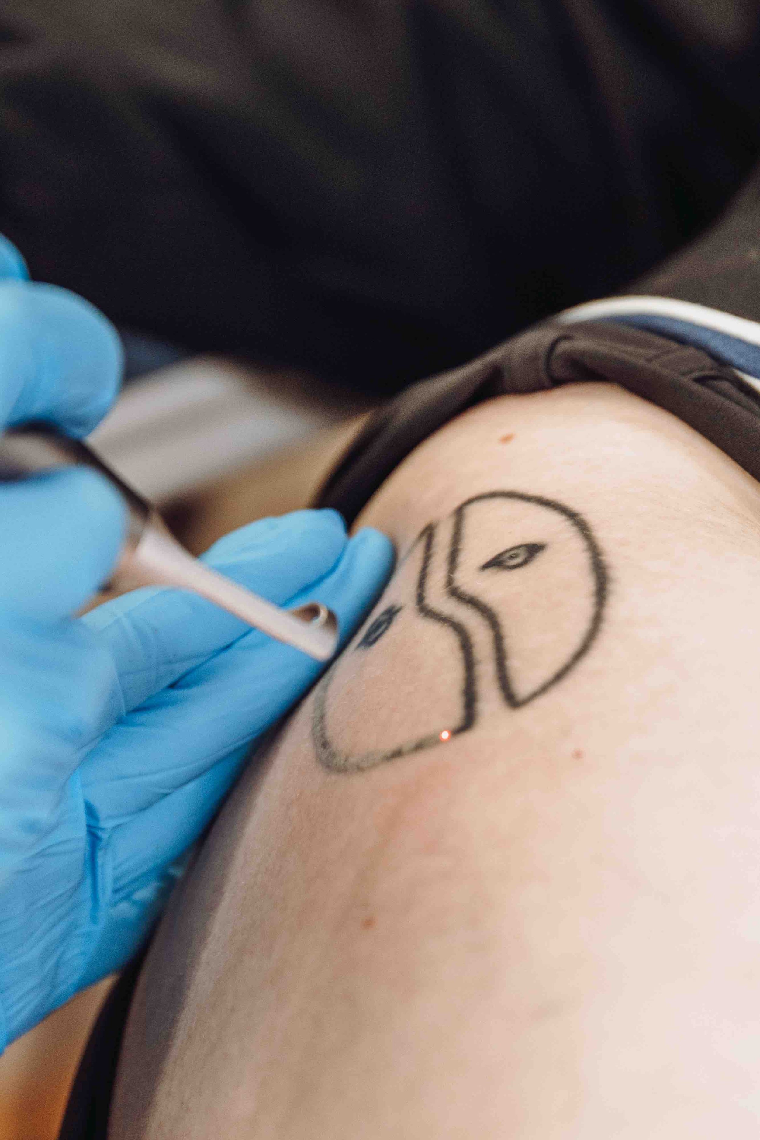 goodphoria-laser-tattoo-removal-old-tattoos.jpeg