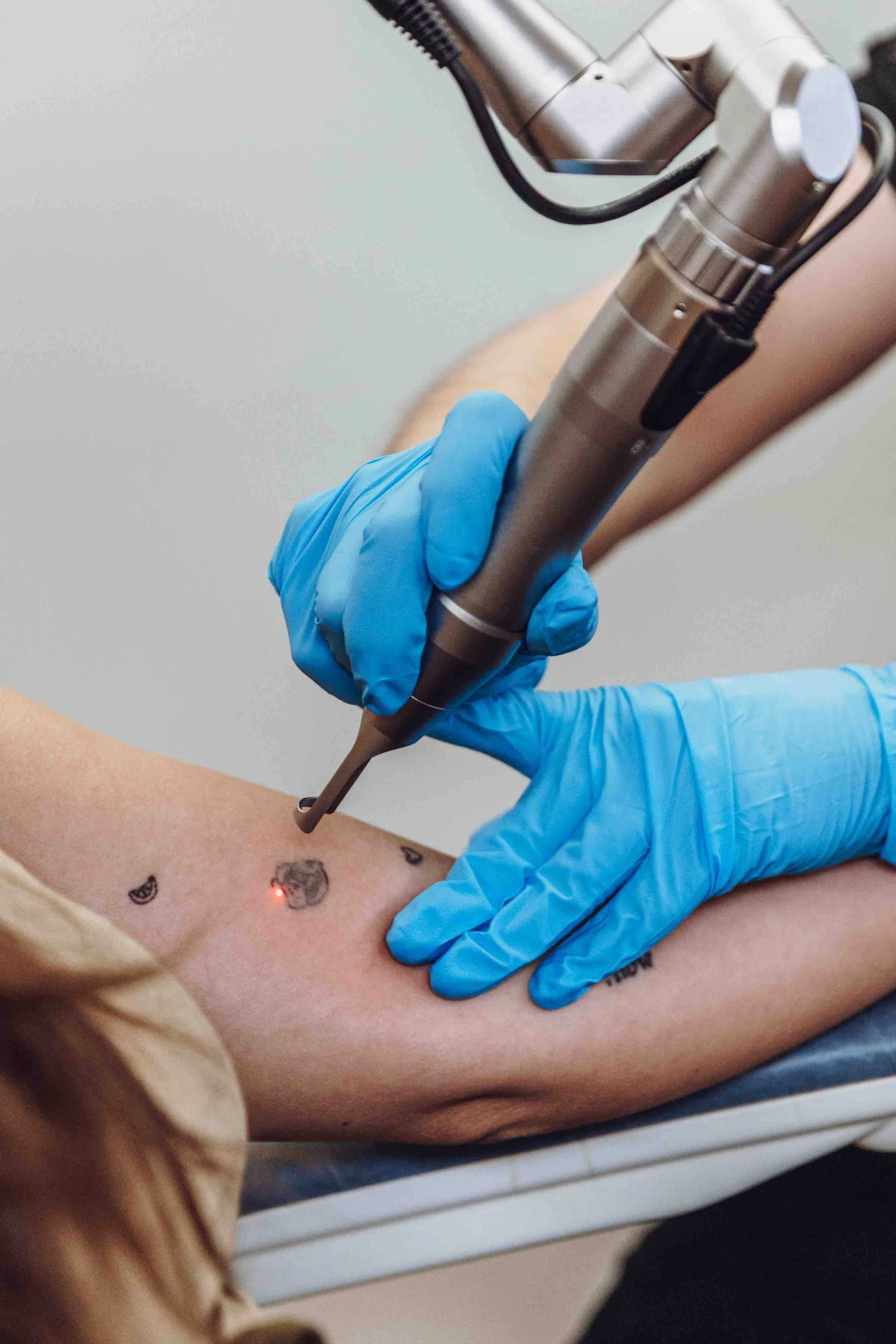 Goodphoria-laser-kiki-arm-tattoo-removal.jpeg
