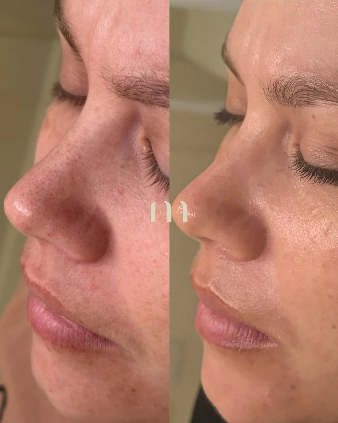 Amazing results for this beautiful client ✨

Achieved after completing our Glass Skin 6-Pack Program.

This program includes professional chemical peels designed to optimise the skin&rsquo;s natural renewal process, paired with LED Light Therapy for 