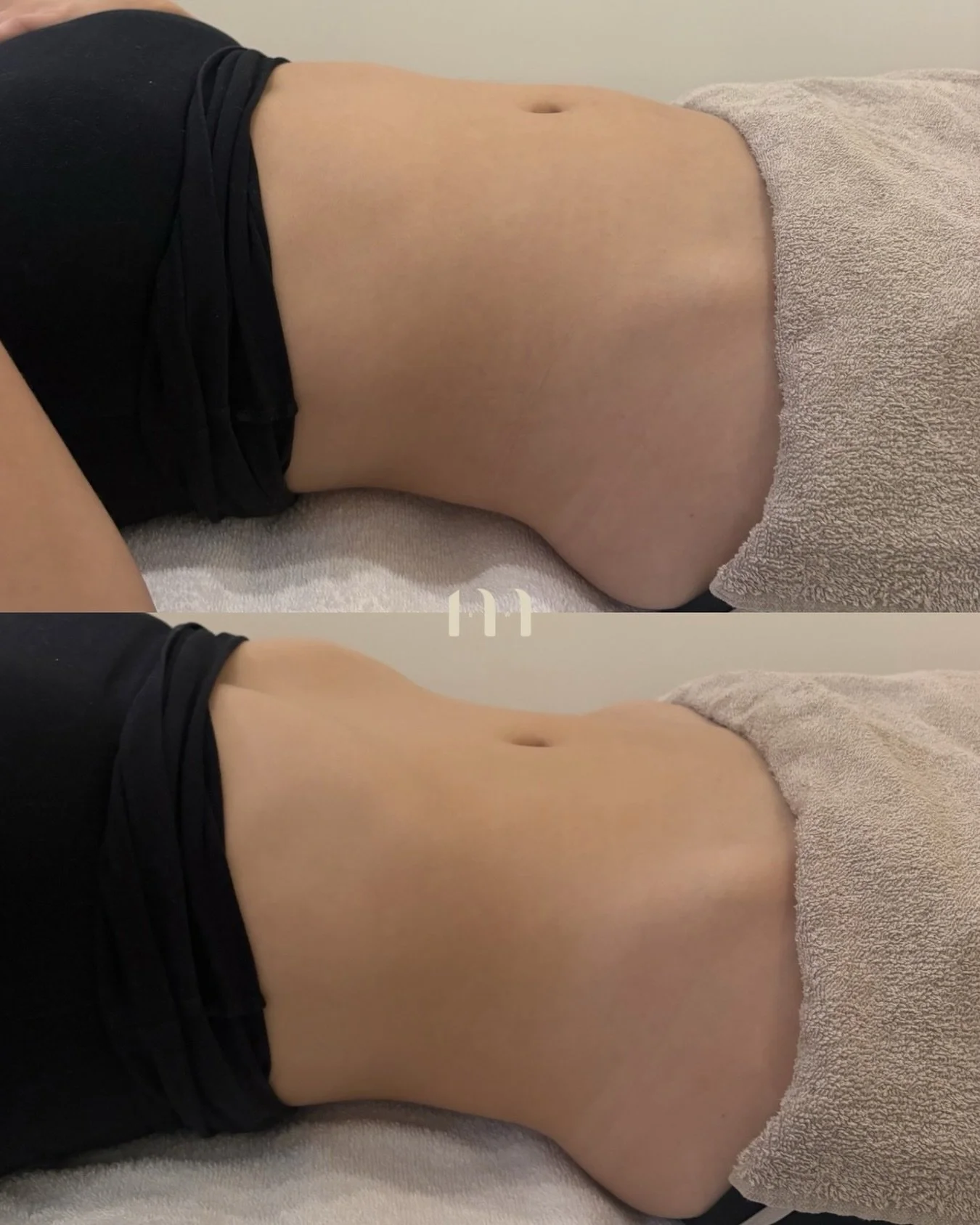 Loving the results from our Integrative Lymphatic Drainage massage ✨

Promoting a deep detox to organs, boosts circulation, assists gut function, reduces inflammation, bloating and much more!